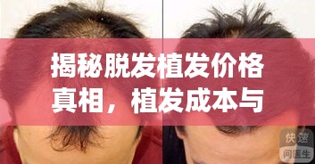 揭秘脫發(fā)植發(fā)價(jià)格真相，植發(fā)成本與最佳方案選擇全解析
