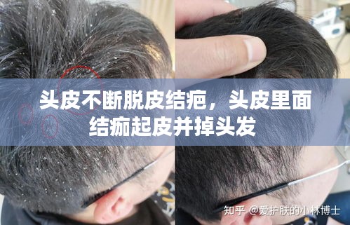 頭皮不斷脫皮結(jié)疤，頭皮里面結(jié)痂起皮并掉頭發(fā) 